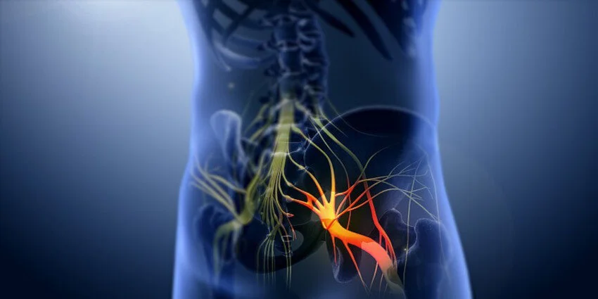 Nerve Pain - Sciatica