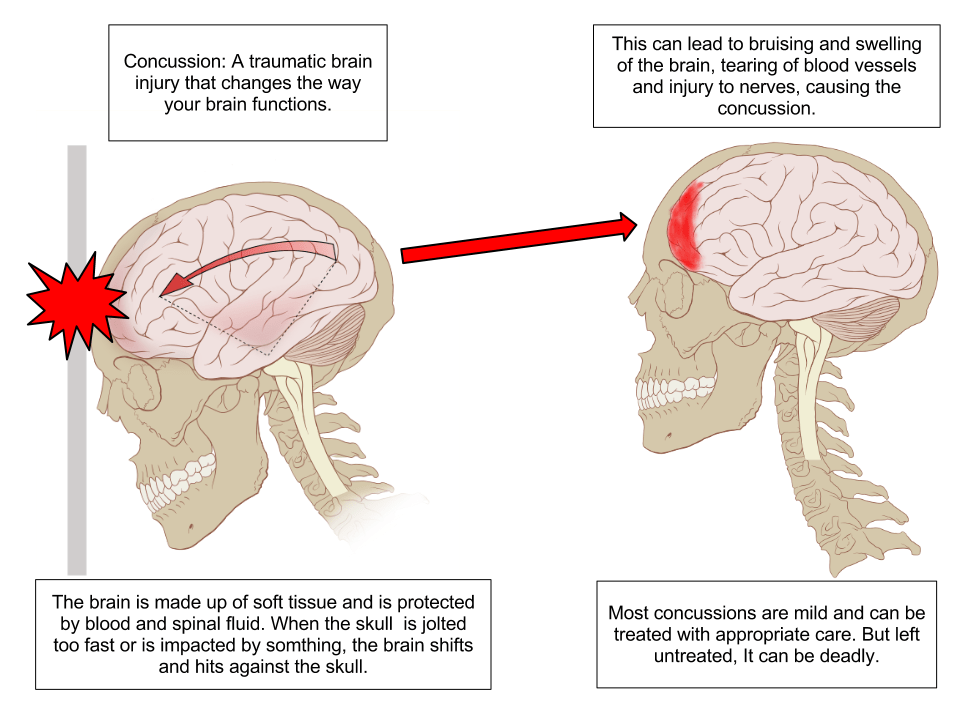 Concussion mTBI