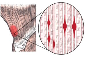 Trigger Point Massage