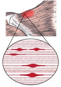 Trigger Points