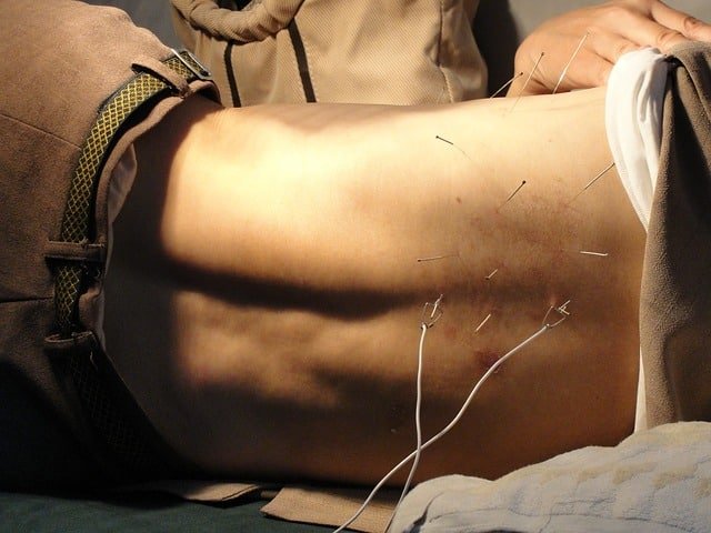 Electroacupuncture Moncton